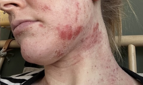 Red rash all over someone's neck and jaw